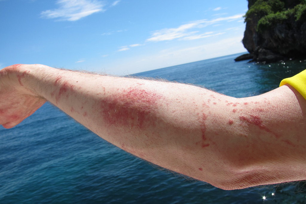 a man's arm with a jellyfish sting